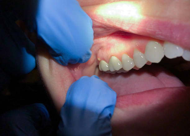 Emergency Dental Filling Replacement in UT